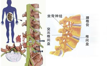 颈椎病导致脑血管病的原因