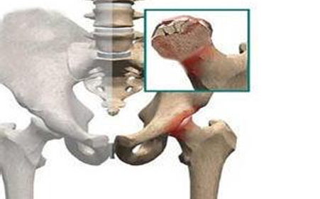股骨头坏死的症状是什么？