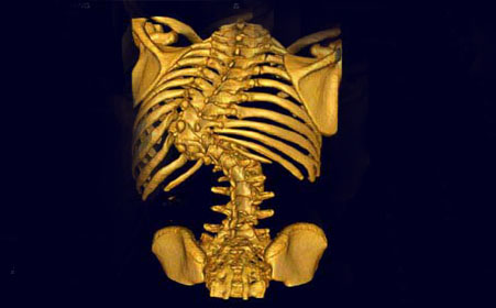 什么是强直性脊柱炎疾病