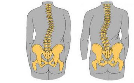 强直性脊柱炎会出现的并发症是什么