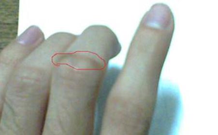 手指关节炎如何护理呢